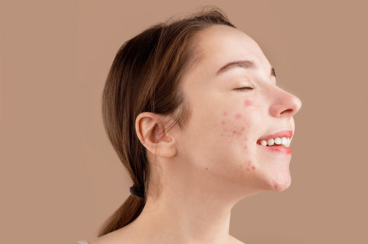 Period Acne: How To Prevent Period Breakouts